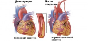 Шунтування судин серця та судин нижніх коненостей: яка вартість лікування та відгуки