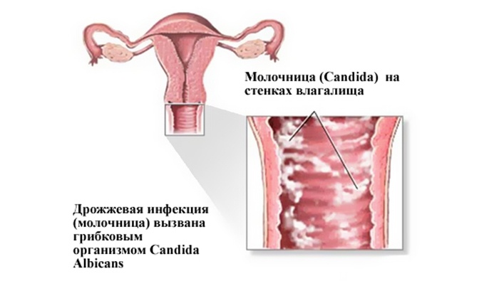 Причини виникнення молочниці у жінок і симптоми захворювання