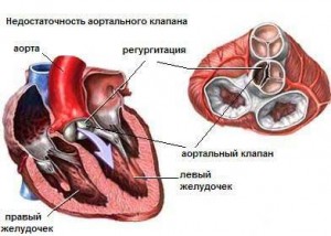 Недостатність аортального клапана: особливості розвитку і ознаки недуги