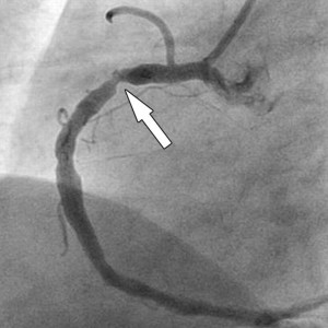 Коронографію серця: що це таке, як роблять операцію і яка ціна лікування