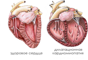 Дилатаційна кардіоміопатія: причини і симптоми захворювання