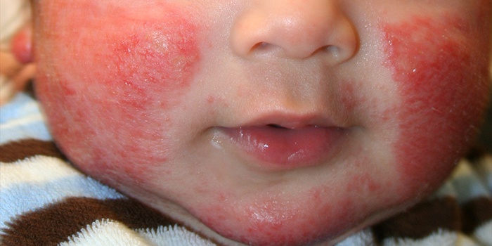 Діатез у новонароджених на обличчі: симптоми, причини і лікування