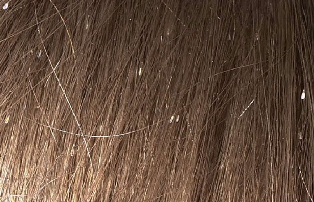 Шампунь від вошей і гнид: як виглядають гниди на волоссі, як швидко вичесати, який вибрати шампунь
