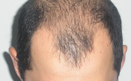 Випадання волосся у чоловіків. Причини і лікування медикаментозними і народними засобами