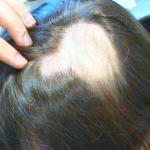 Боротьба за густину: чому інтенсивно випадає волосся і як це зупинити