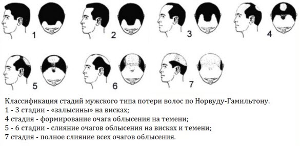 Випадання волосся у чоловіків. Причини і лікування медикаментозними і народними засобами