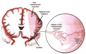 Ішемія головного мозку: симптоми і лікування захворювання