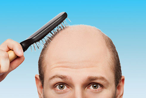 Причини випадіння волосся у чоловіків — вихід є завжди