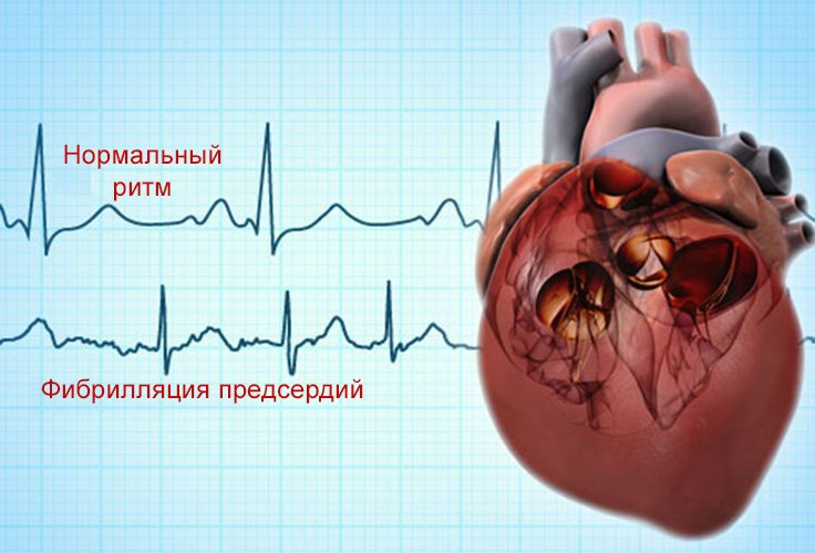 Миготлива аритмія серця, причини і симптоми, лікування недуги