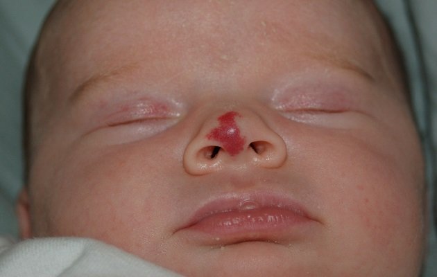 Лікування гемангіоми у новонароджених дітей