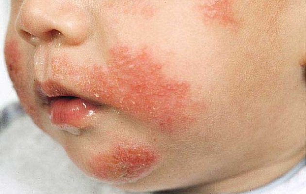 Атопічний дерматит у дітей: лікування, дієта і прикорм