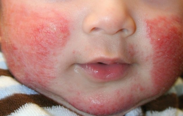 Атопічний дерматит у дітей: лікування, дієта і прикорм