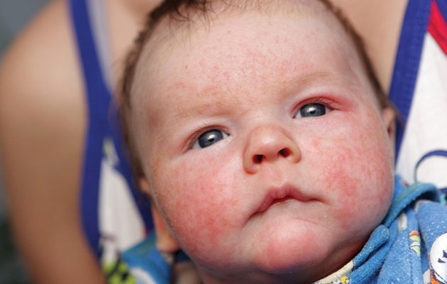 Висип на обличчі, тілі і щоках у немовляти   як лікувати немовля?
