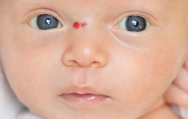 Лікування гемангіоми у новонароджених дітей