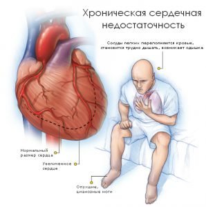 Кашель при серцевій недостатності: симптоми і способи лікування