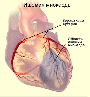 Ішемічна хвороба серця: лікування, причини виникнення, симптоми