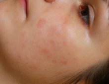 Червоні плями на обличчі: причини, лікування, методи боротьби