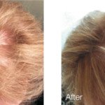 Озонотерапія — вплив на волосся, особливості, ціна