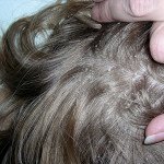 Як ефективно позбутися від лупи і призупинити випадання волосся