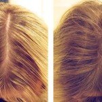 Високотехнологічне напрямок в естетичній косметології волосся – ботокс!