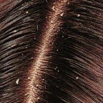 Як ефективно позбутися від лупи і призупинити випадання волосся