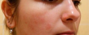 Червоні плями на обличчі: причини, лікування, методи боротьби