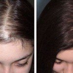 Озонотерапія — вплив на волосся, особливості, ціна