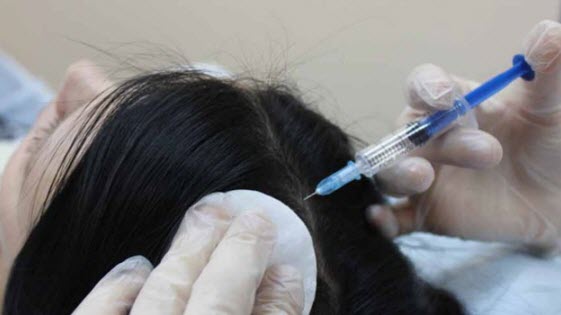 Озонотерапія при випаданні і для стимуляції росту волосся: суть, властивості та відгуки про процедуру