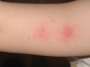 Як відрізнити укус комара від алергії