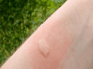 Як відрізнити укус комара від алергії