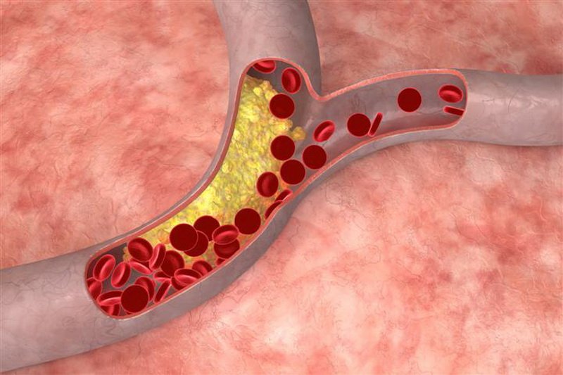 Підвищений холестерин у крові, чим це загрожує? Які існують методи його зниження?