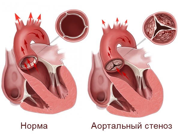 Набутий порок серця, як розвивається і яким воно буває?