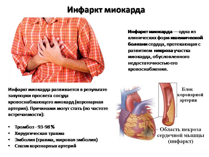 Форми інфаркту міокарда, якими вони бувають і як проявляються?
