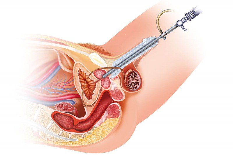 Підготовка і проведення цистоскопії сечового міхура
