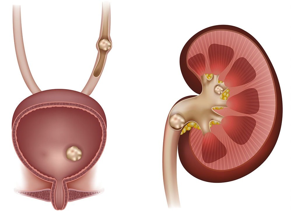 Каликоэктазия правої і лівої нирки — причини, ознаки і лікування