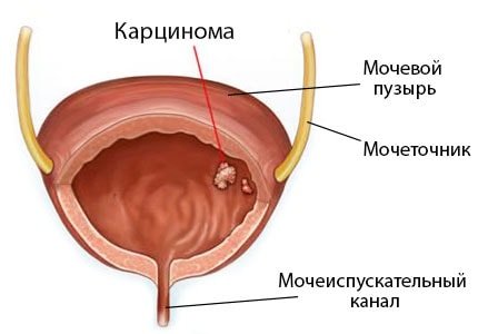 Рак сечового міхура у чоловіків: симптоми і лікування