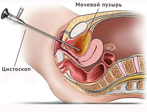 Підготовка і проведення цистоскопії сечового міхура