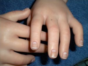 Значення родимки на середньому пальці лівої і правої руки для чоловіків і жінок
