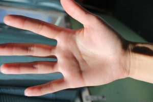 Значення родимки на великому пальці лівої і правої руки для чоловіків і жінок