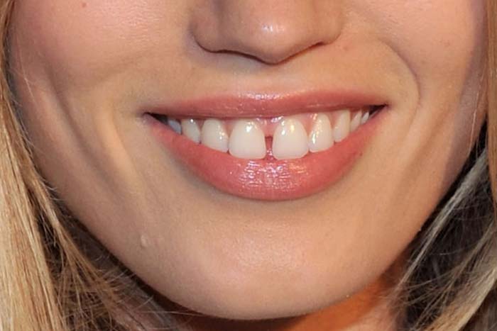 Прикмета   щербинка між зубами: що означає щілину між передніми зубами