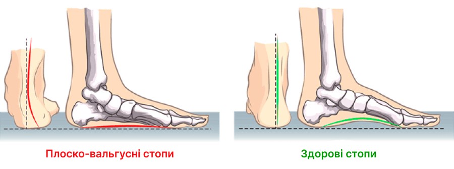 Плоско вальгусна деформація стопи у дітей – що робити?