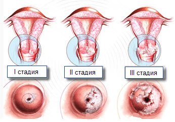 Все найважливіше про біопсії шийки матки