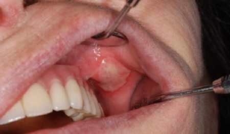 Стоматит у роті як лікувати thumbnail