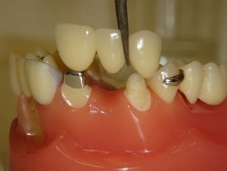 Скільки коштує вставити один зуб?