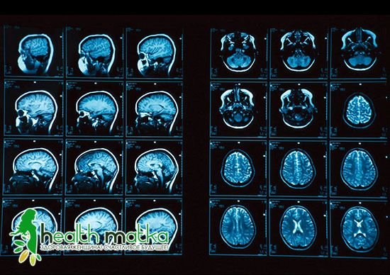 МРТ головного мозку: своєчасна діагностика захворювань