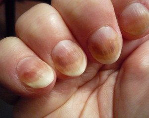 Причини нігтів, що шаруються і способи лікування