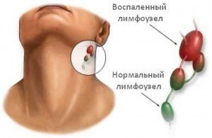 Лімфаденіт