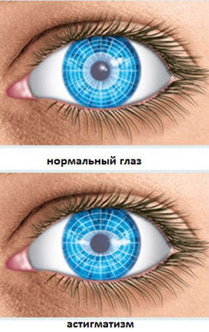 Астигматизм очей: симптоми захворювання, способи лікування і профілактики