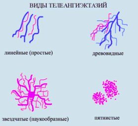 Видалення судинних зірочок на ногах