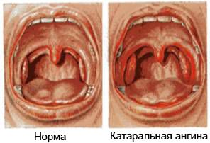 Чим небезпечна катаральна ангіна?